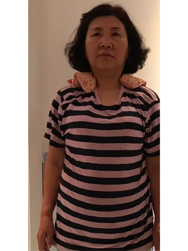 耳ツボダイエットで痩せました！ ビフォー